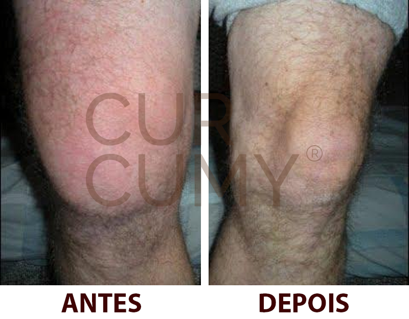 CURCUMY® - Fórmula Avançada para o Combate das Dores - LEVE 3 e PAGUE 2